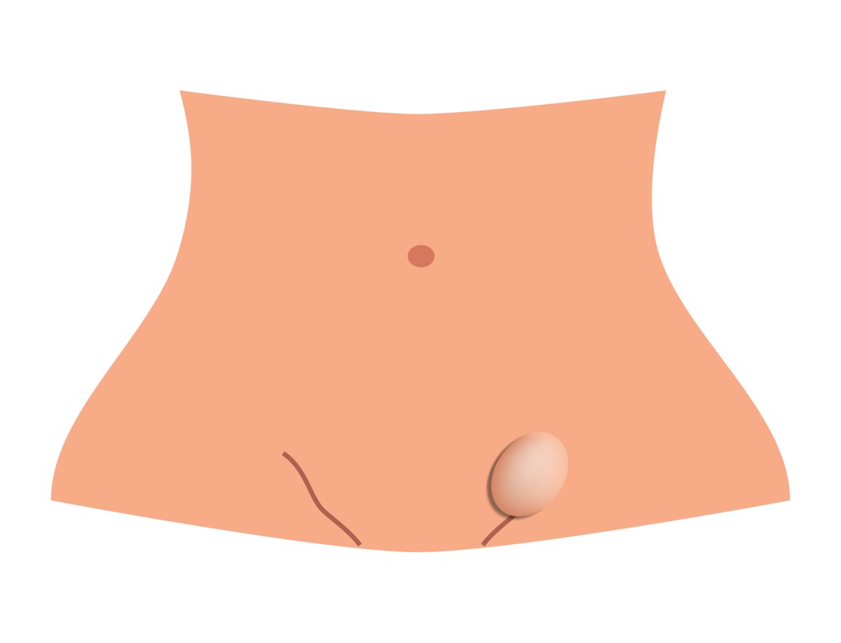 Hernia inguinal